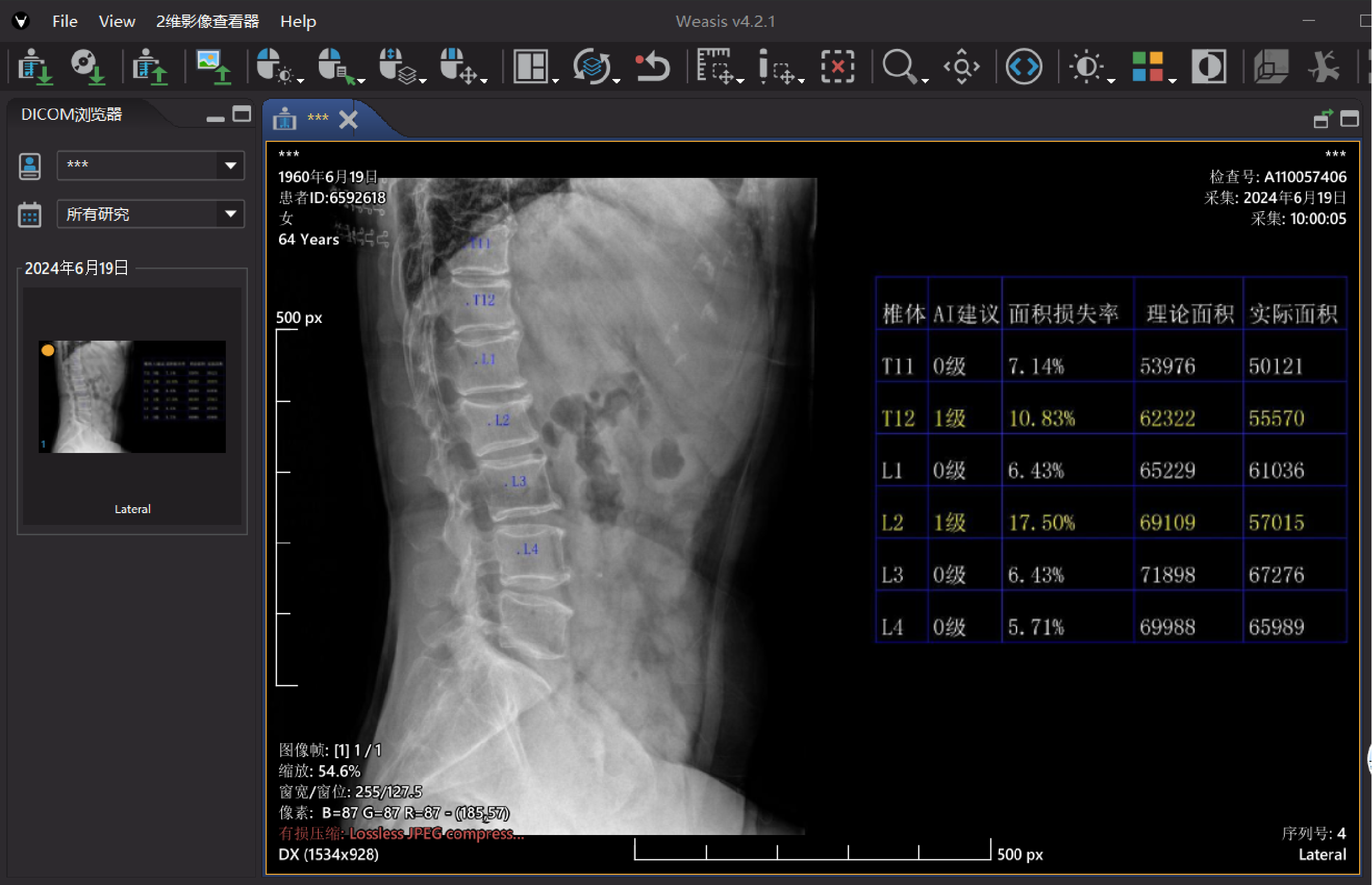 椎体X射线影像处理软件(基于X线片)